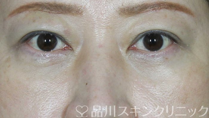 症例NO.72234のAFTER写真