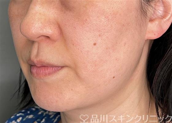 症例NO.59132のBEFORE写真