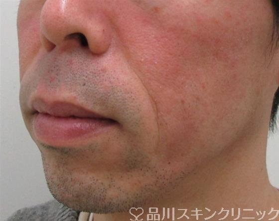 症例NO.33447のBEFORE写真