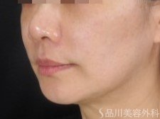 症例NO.73203のBEFORE写真