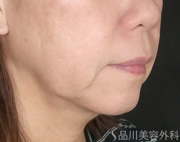 症例NO.65289のBEFORE写真