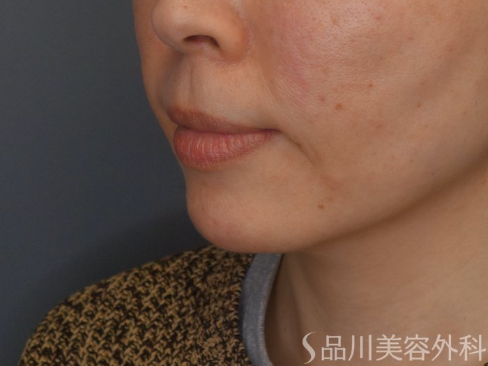 症例NO.69216のBEFORE写真
