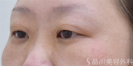 症例NO.61016のBEFORE写真