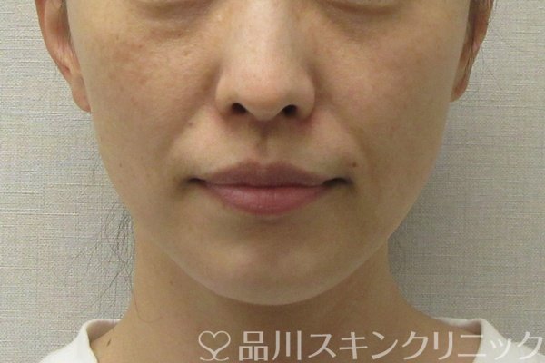 症例NO.74647のBEFORE写真
