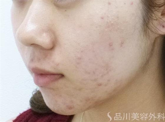 症例NO.24281のBEFORE写真
