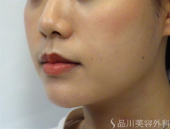 症例NO.40178のAFTER写真