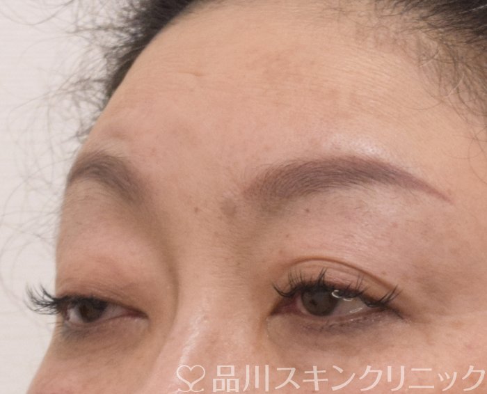 症例NO.75255のBEFORE写真