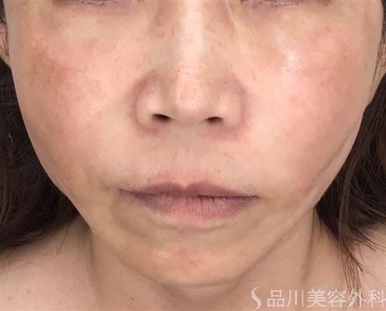 症例NO.52175のAFTER写真