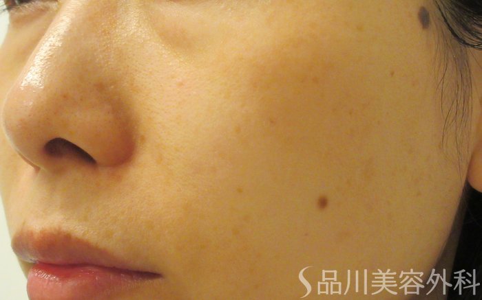 症例NO.70614のAFTER写真