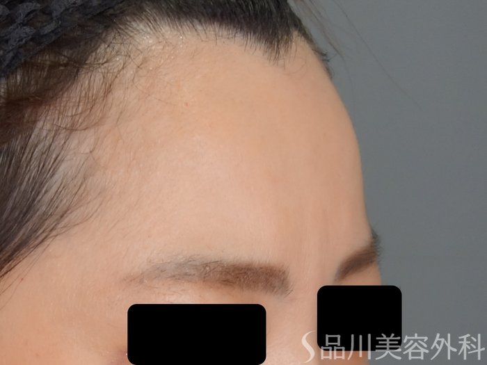 症例NO.69750のBEFORE写真