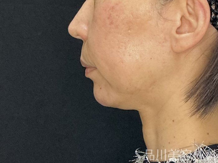 症例NO.72573のAFTER写真