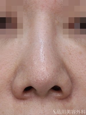 症例NO.74727のBEFORE写真