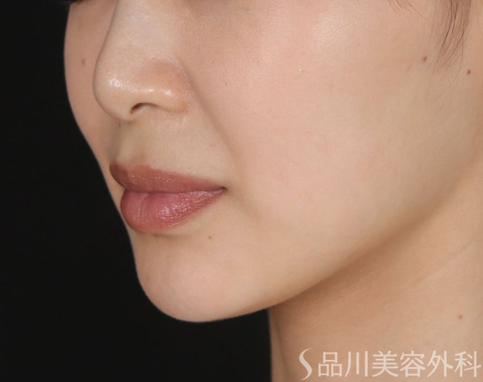 症例NO.73706のAFTER写真