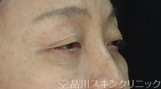 症例NO.72242のAFTER写真