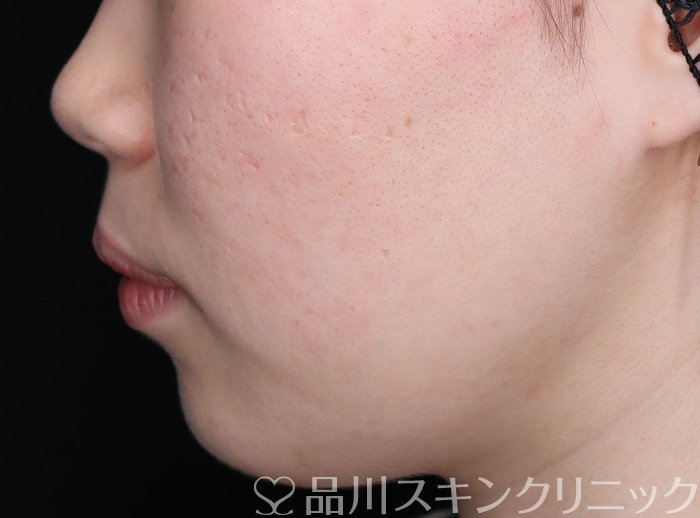 症例NO.69347のAFTER写真