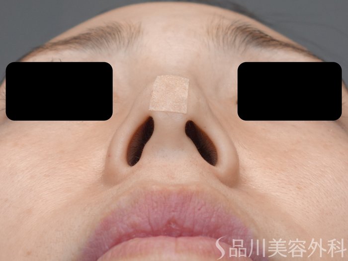 症例NO.72407のAFTER写真