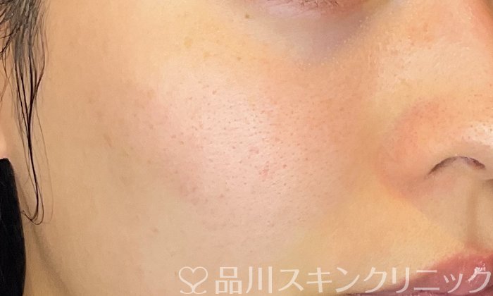 症例NO.74591のAFTER写真