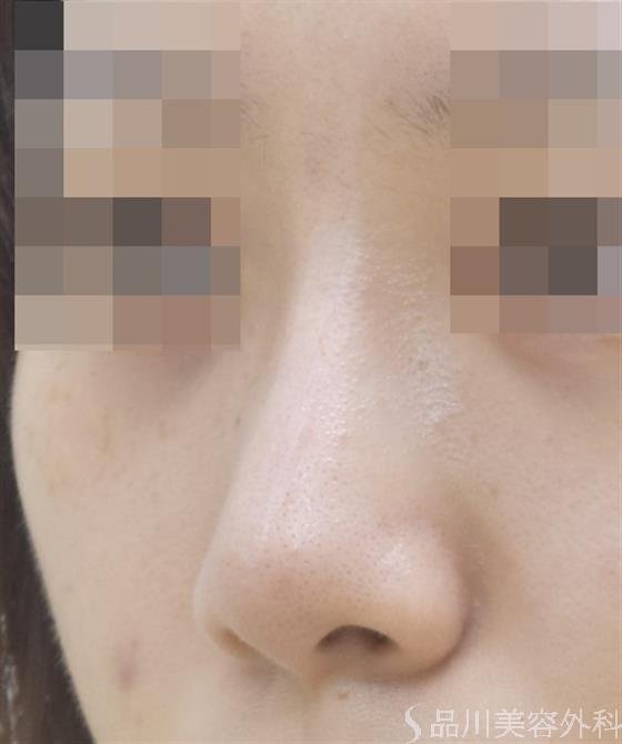 症例NO.44619のAFTER写真