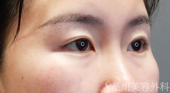 症例NO.69334のBEFORE写真