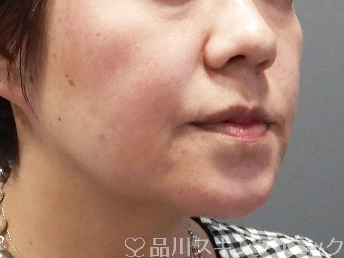 症例NO.71855のBEFORE写真