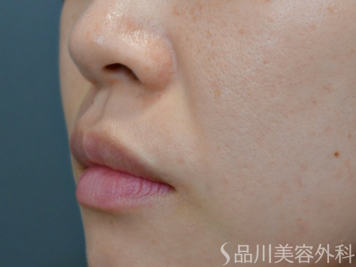 症例NO.71738のBEFORE写真