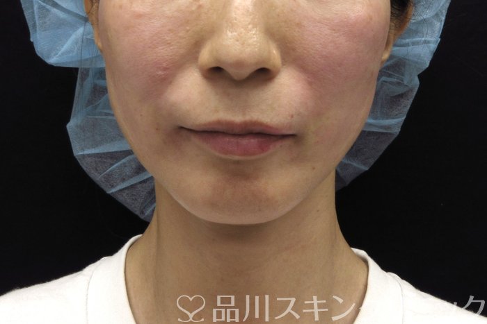 症例NO.74475のAFTER写真