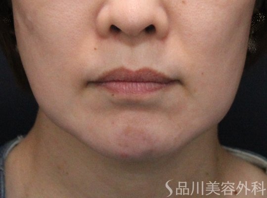 症例NO.75257のBEFORE写真