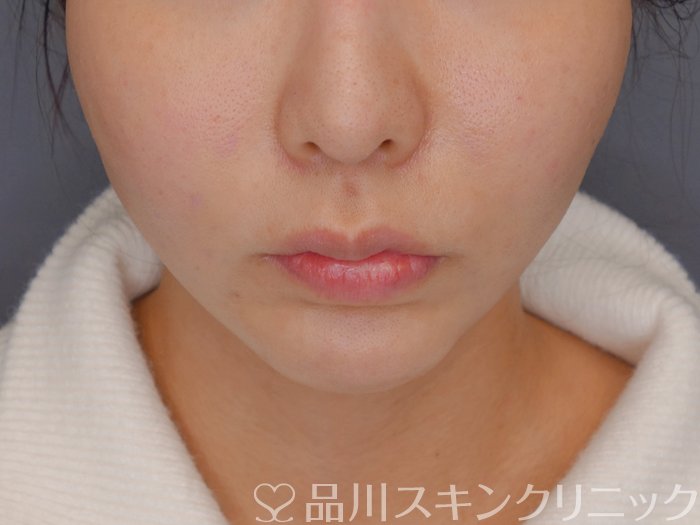 症例NO.72303のAFTER写真