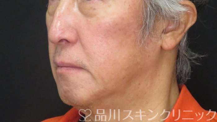 症例NO.73480のBEFORE写真