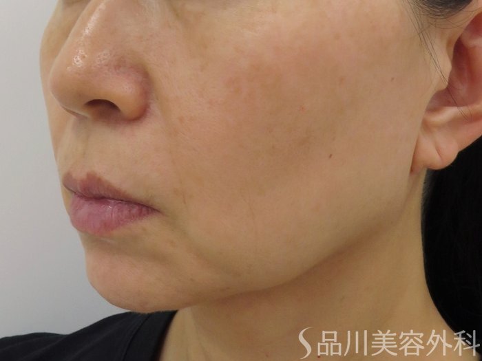 症例NO.73760のBEFORE写真