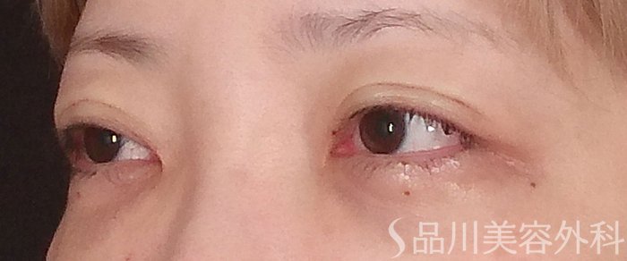 症例NO.70574のAFTER写真