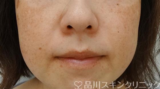 症例NO.31674のBEFORE写真