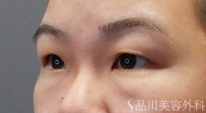 症例NO.71525のBEFORE写真