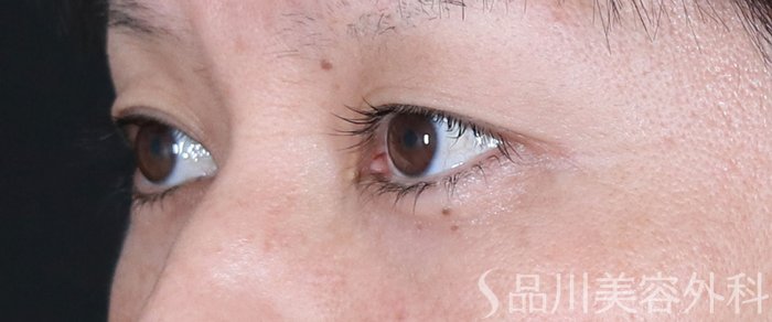 症例NO.72751のBEFORE写真