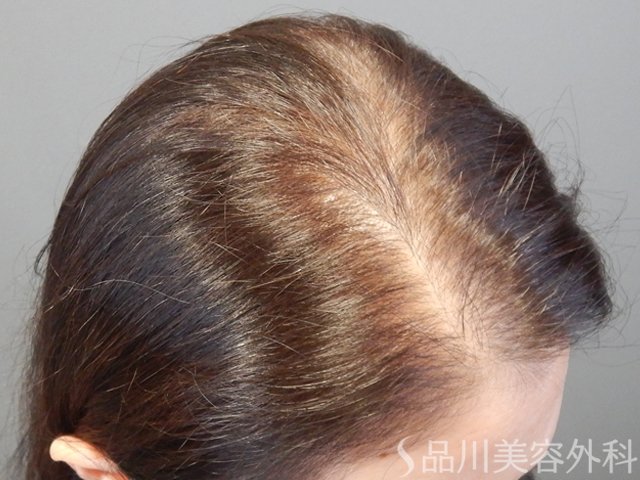 症例NO.68636のBEFORE写真