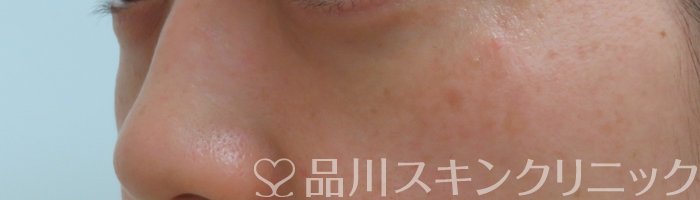 症例NO.66520のAFTER写真