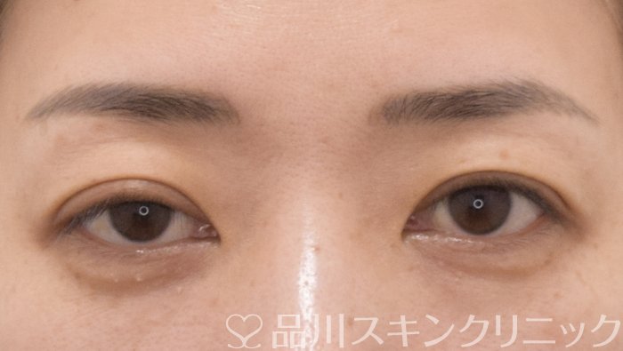 症例NO.70969のBEFORE写真