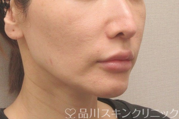 症例NO.73067のBEFORE写真