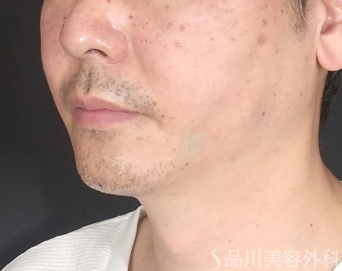症例NO.65260のAFTER写真