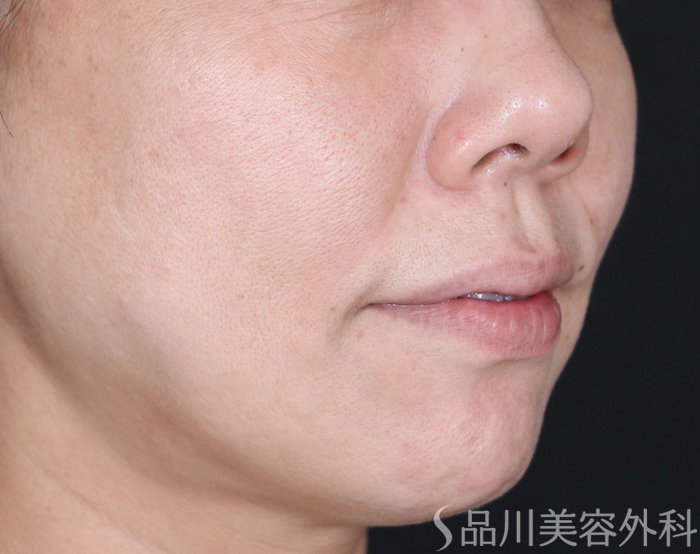 症例NO.71416のBEFORE写真