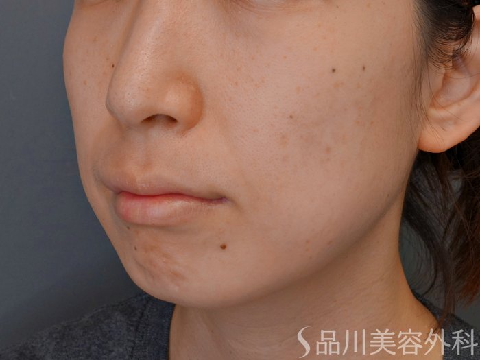 症例NO.73636のBEFORE写真