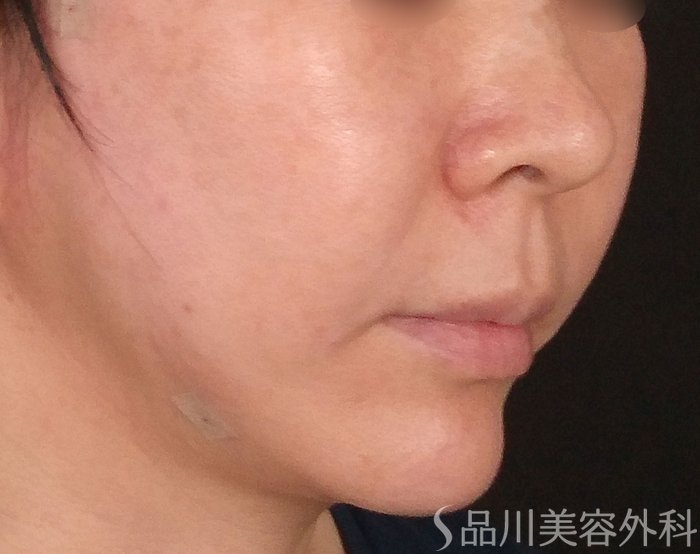 症例NO.70212のAFTER写真