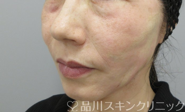 症例NO.70086のAFTER写真