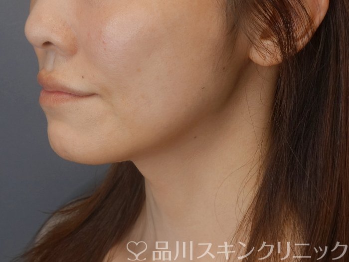 症例NO.72519のAFTER写真