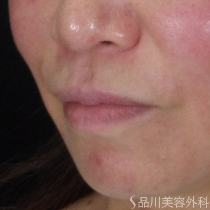 症例NO.70804のBEFORE写真