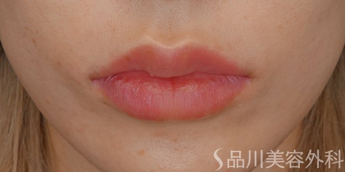 症例NO.72195のAFTER写真