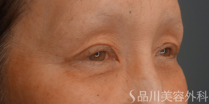 症例NO.73421のBEFORE写真