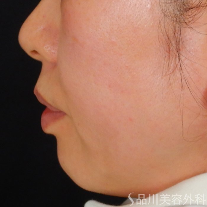 症例NO.67940のBEFORE写真