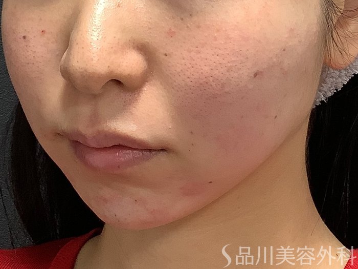 症例NO.75306のAFTER写真