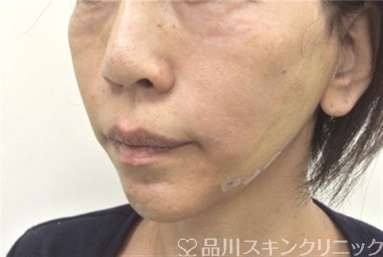 症例NO.30768のAFTER写真